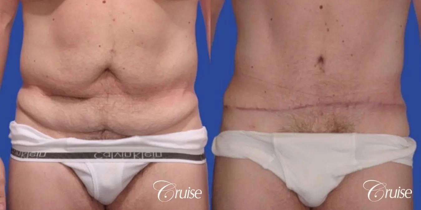 best male with abdominoplasty tummy tuck extended scar - Before and After 1