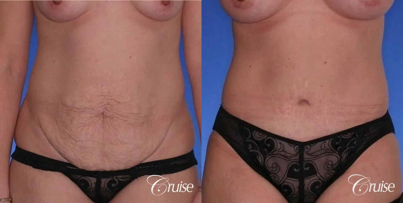best standard tummy tuck for excess skin - Before and After 1
