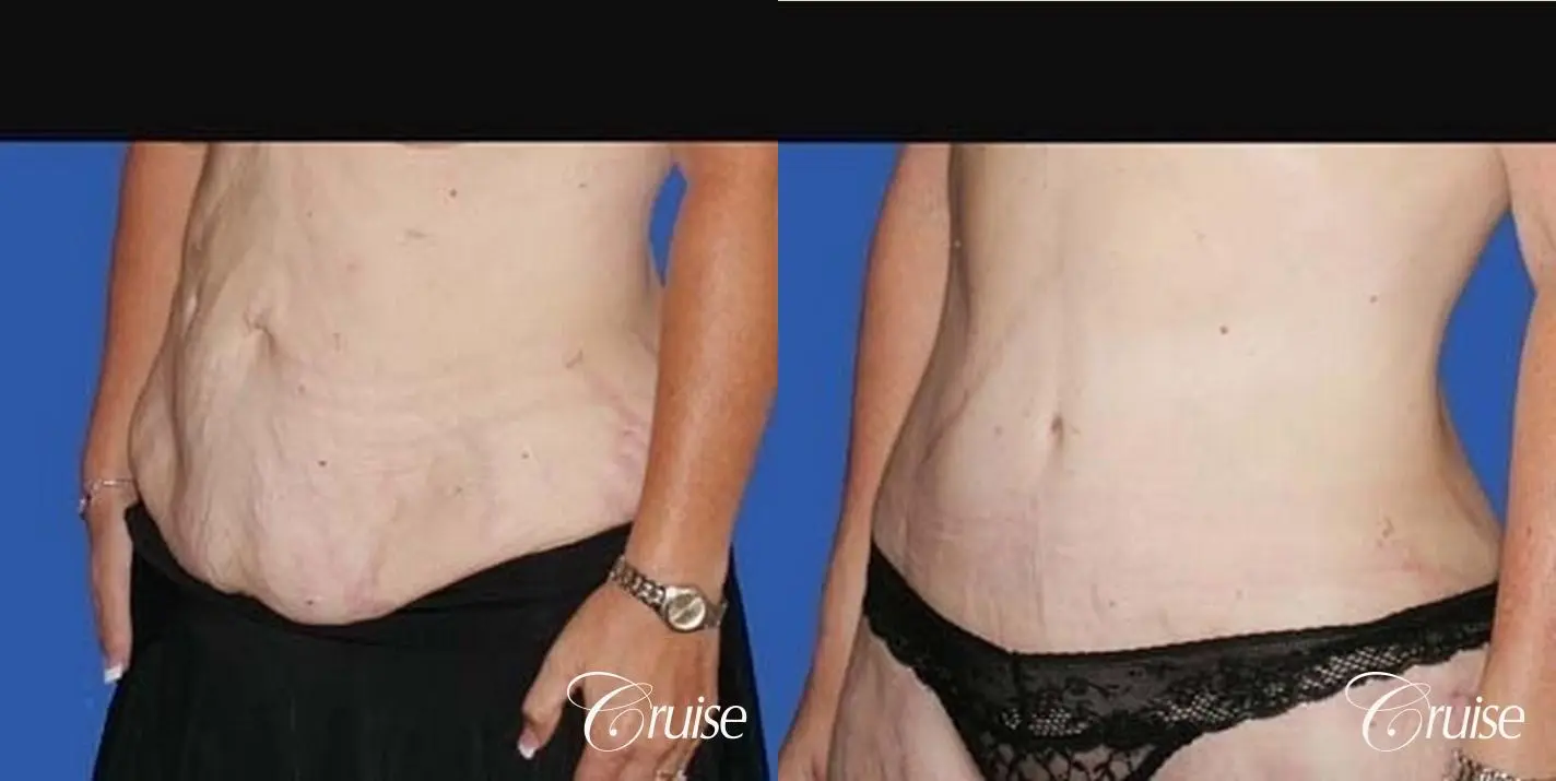 best plastic surgeon for extended tummy tuck after weight loss - Before and After 2