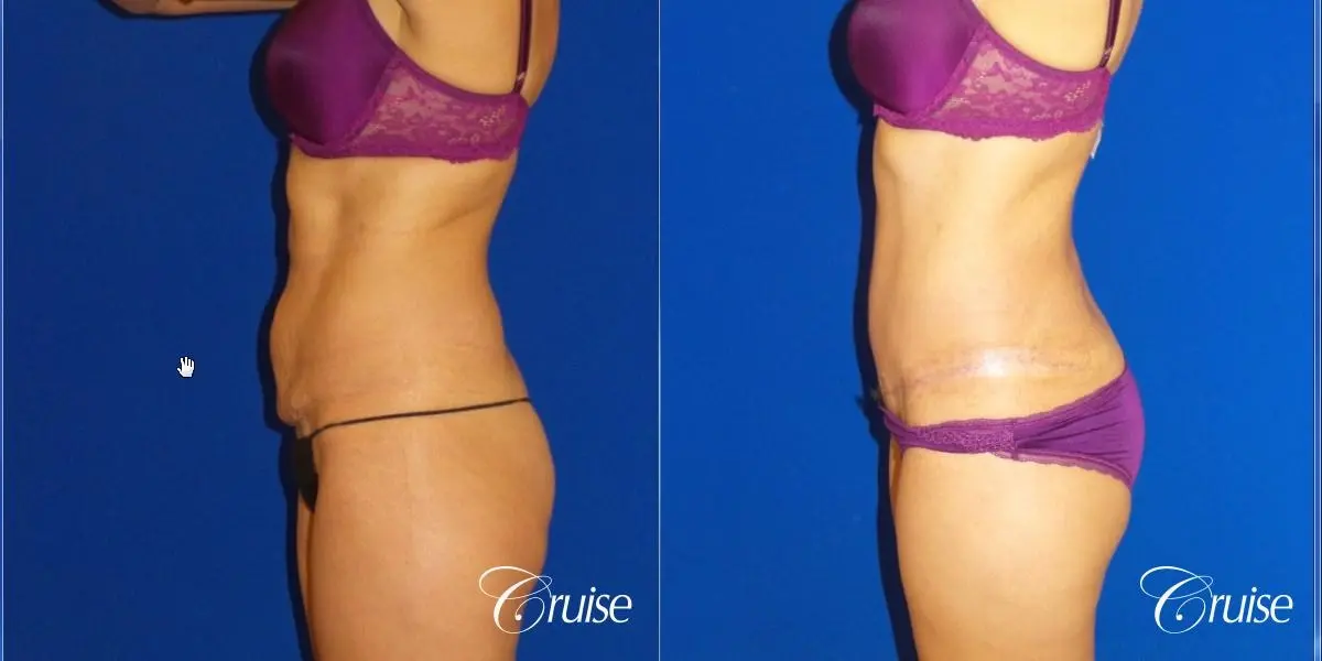 Tummy Tuck Extended Incision - Before and After 3