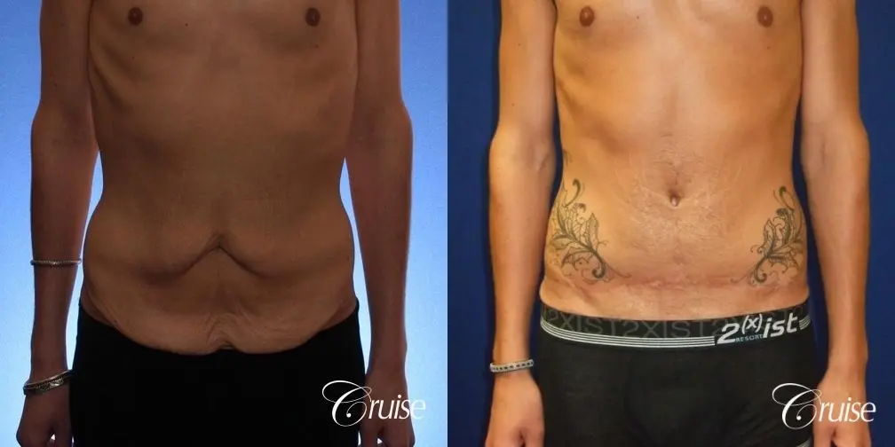 Tummy Tuck Before & After Gallery: Patient 74