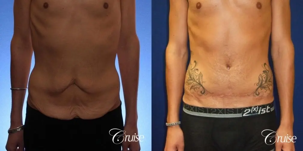 Weight Loss Tummy Tuck: 22 Yr Old Male - Before and After 1