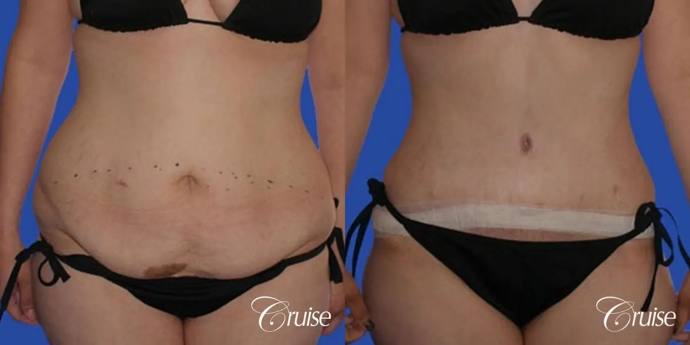 large tummy tuck on young girl - Before and After 1