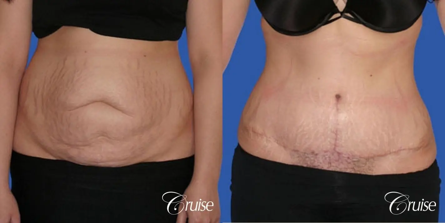 best standard tummy tuck abdominoplasty - Before and After 1