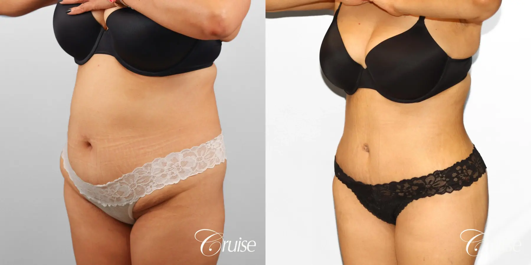 Tummy Tuck: Patient 78 - Before and After 2