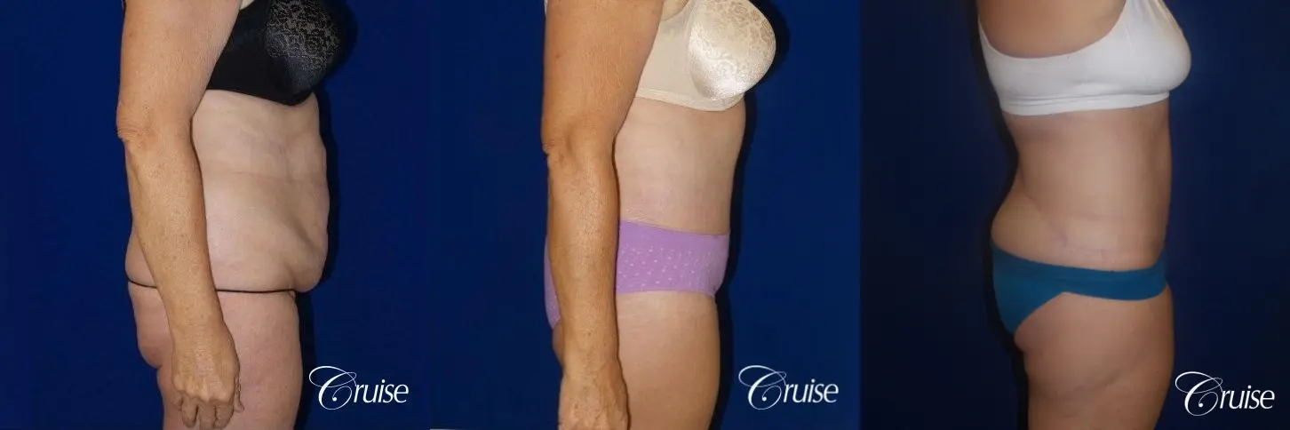 62 Yr Old Female Circumferential Tummy Tuck w/BBL & Liposuction - Before and After 3