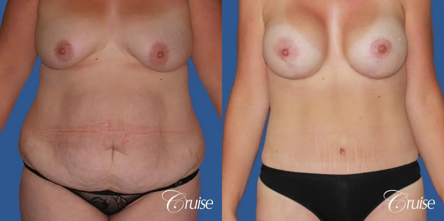 best before and after tummy tuck - Before and After