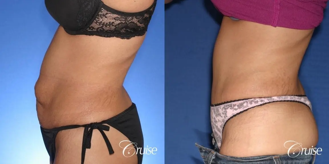 Tummy Tuck: Patient 59 - Before and After 2