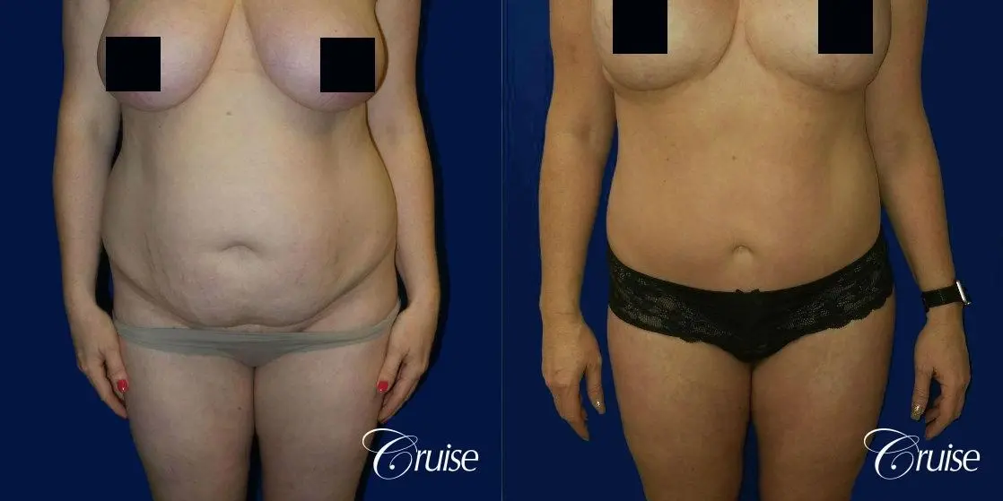 Best tummy tucks dr cruise - Before and After