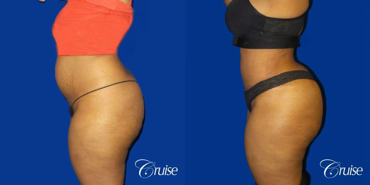 Best Tummy Tuck surgeons Newport Beach - Before and After 3