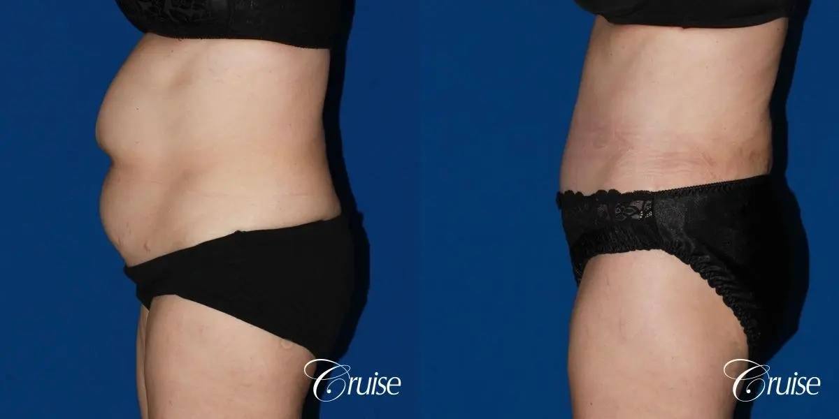 Tummy Tuck: Patient 28 - Before and After 2