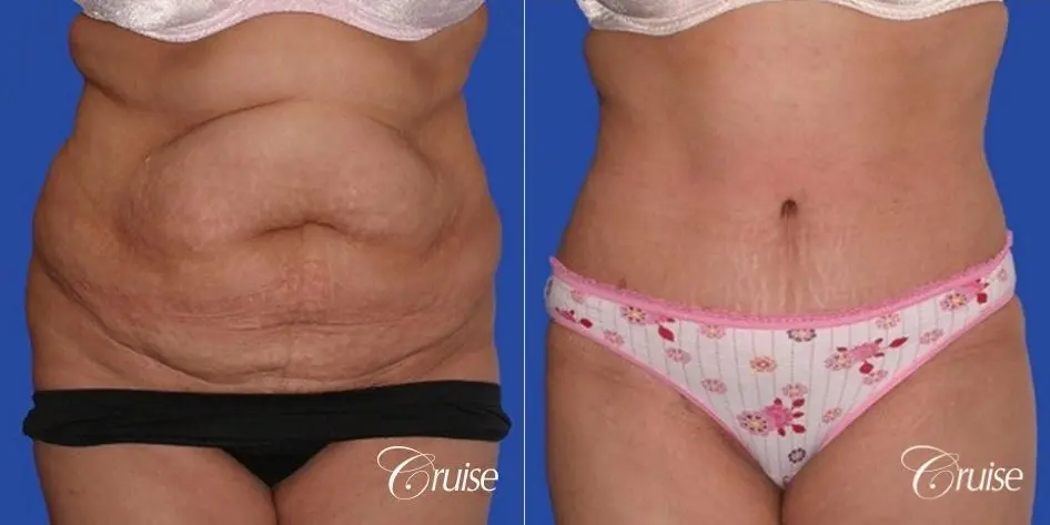best tummy tuck plastic surgeon - Before and After