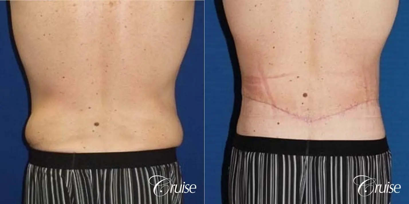 Best male circumferential tummy tuck - Before and After 5