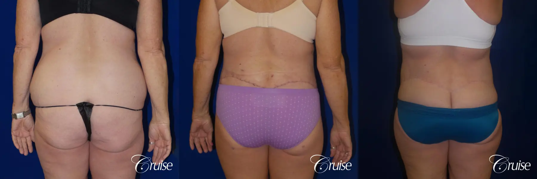 62 Yr Old Female Circumferential Tummy Tuck w/BBL & Liposuction - Before and After 6
