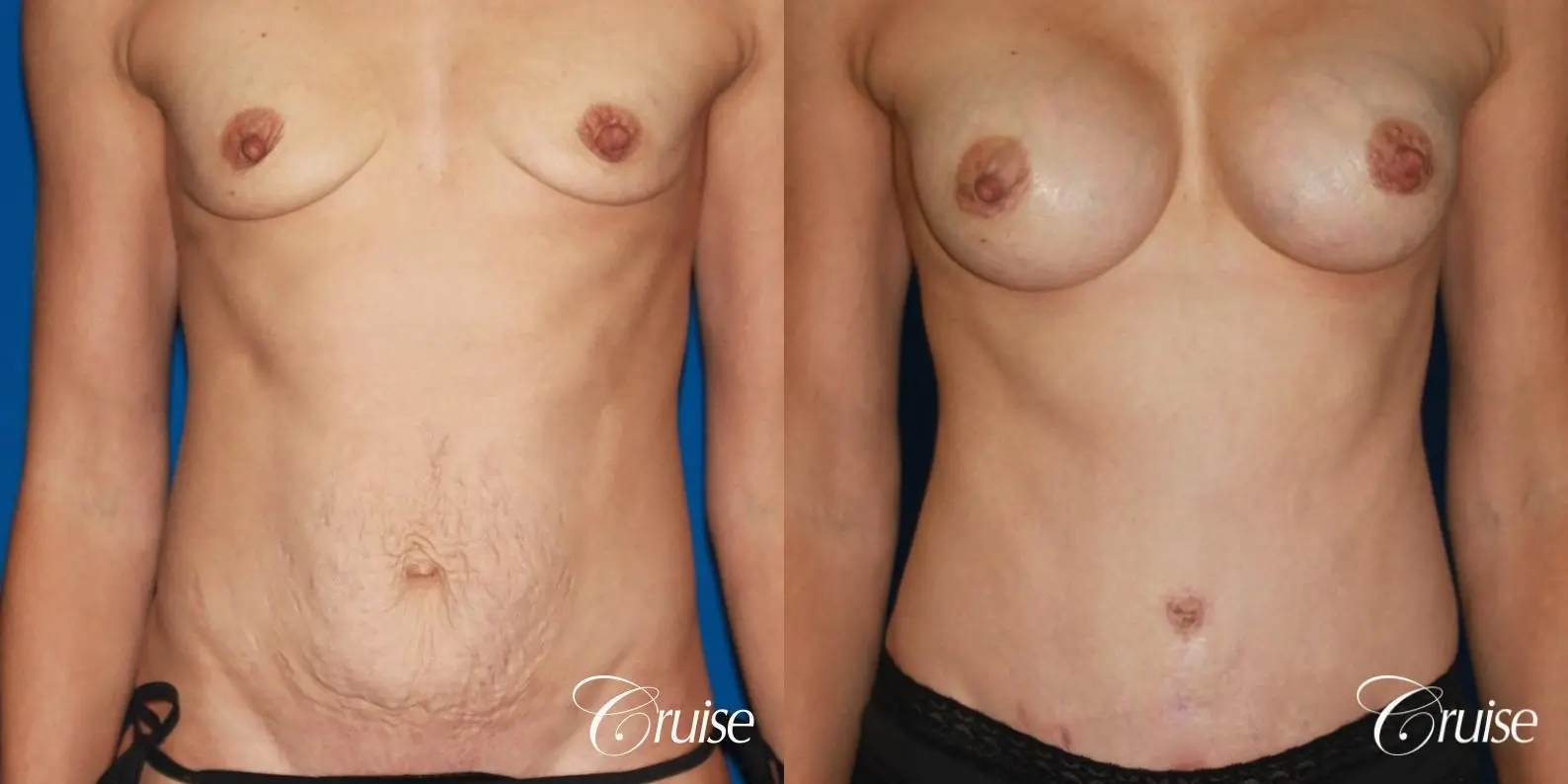 Tummy Tuck: Patient 25 - Before and After 1