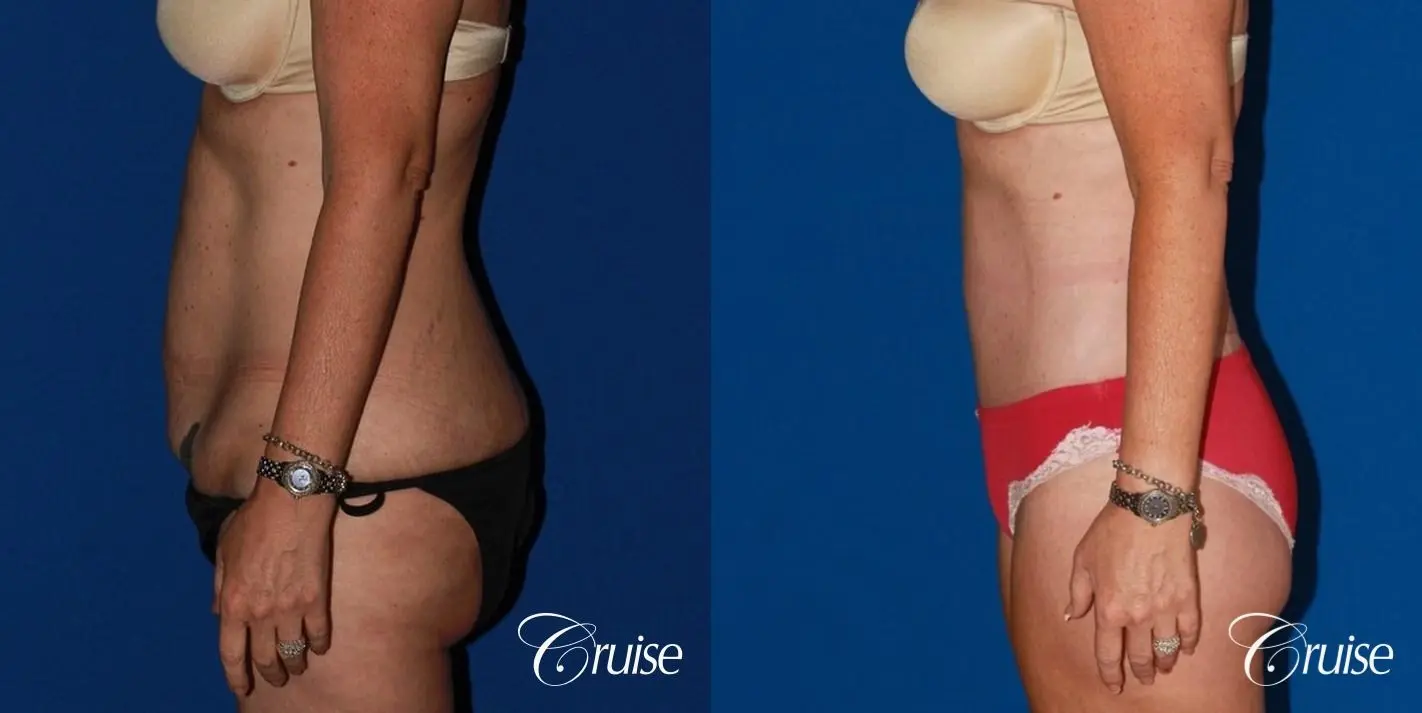 best circumferential body lift tummy tuck scar - Before and After 2