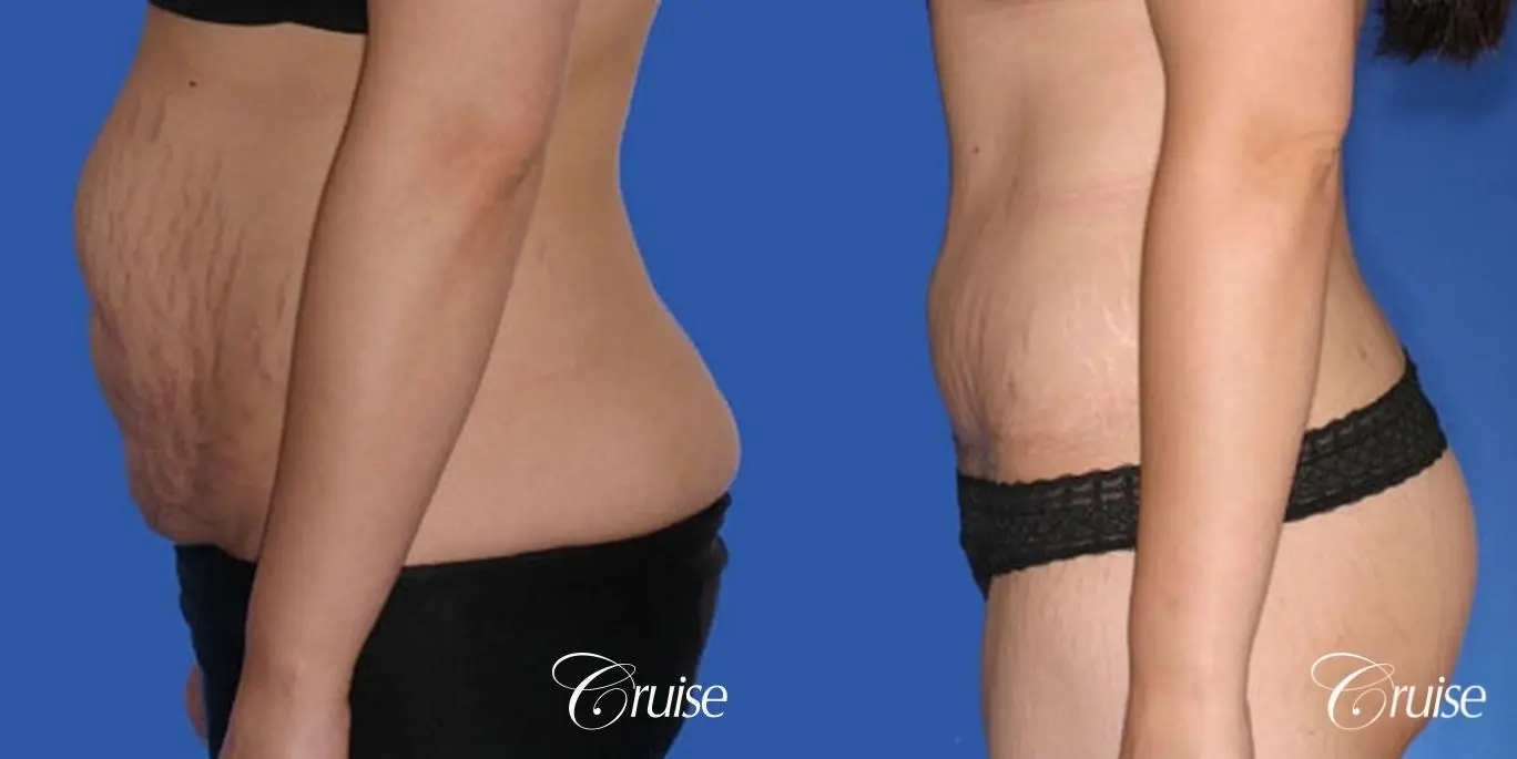 best standard tummy tuck abdominoplasty - Before and After 2