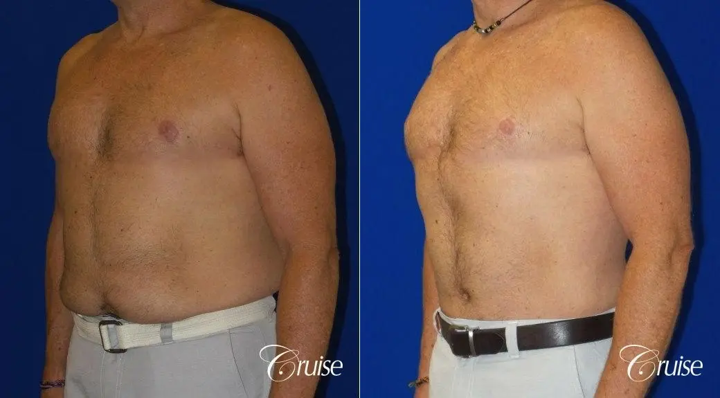 Standard Tummy Tuck & Liposuction: 54 Yr Old Male - Before and After 3