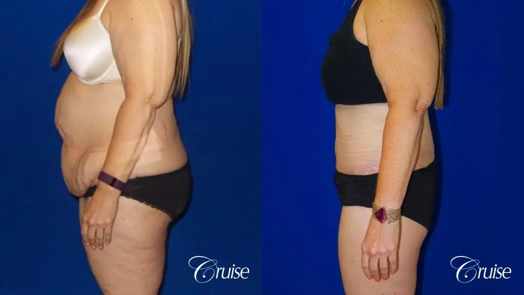 Tummy Tuck Circumferential Incision - Before and After 4
