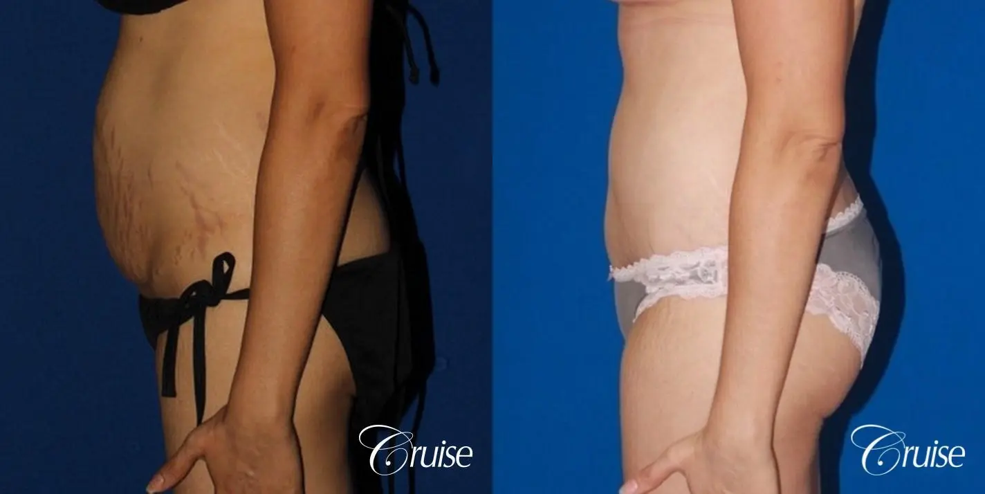 best female body lift with circumferential scar - Before and After 2