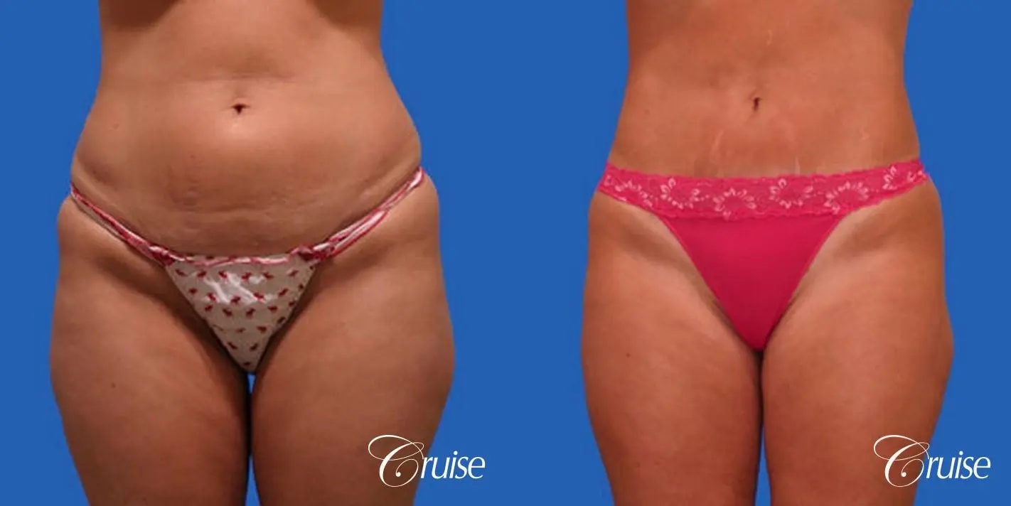 best pictures of mini tummy tuck for skin only on skinny female - Before and After 1
