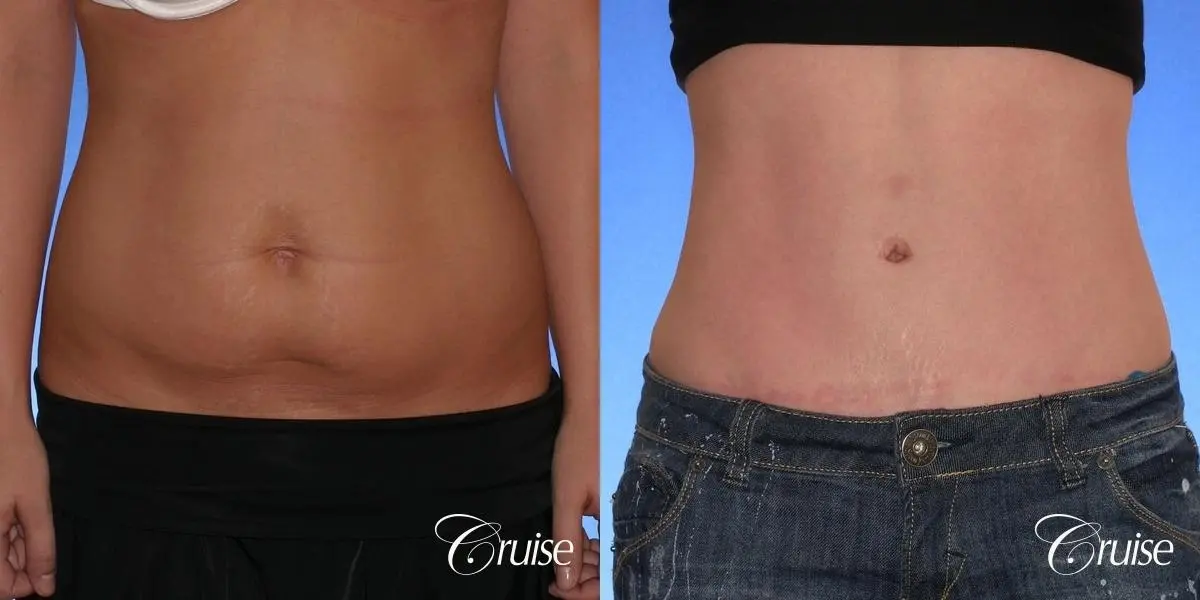 Tummy Tuck: Patient 34 - Before and After 1