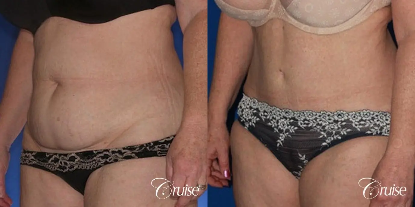 female photos of tummy tuck results - Before and After 3