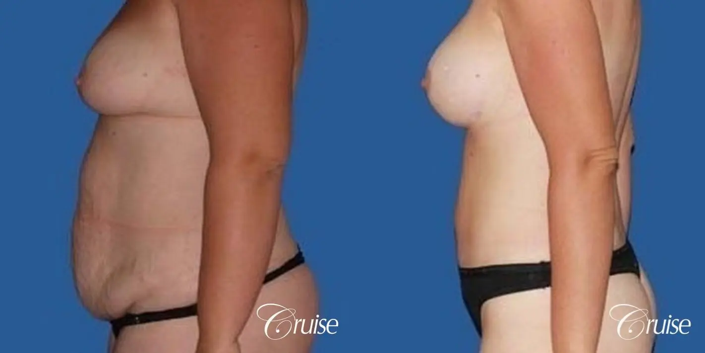 best before and after tummy tuck - Before and After 2