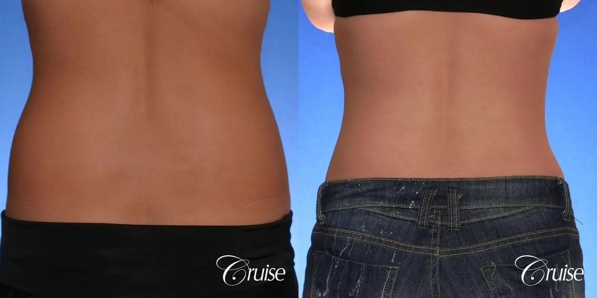 Tummy Tuck: Patient 34 - Before and After 3