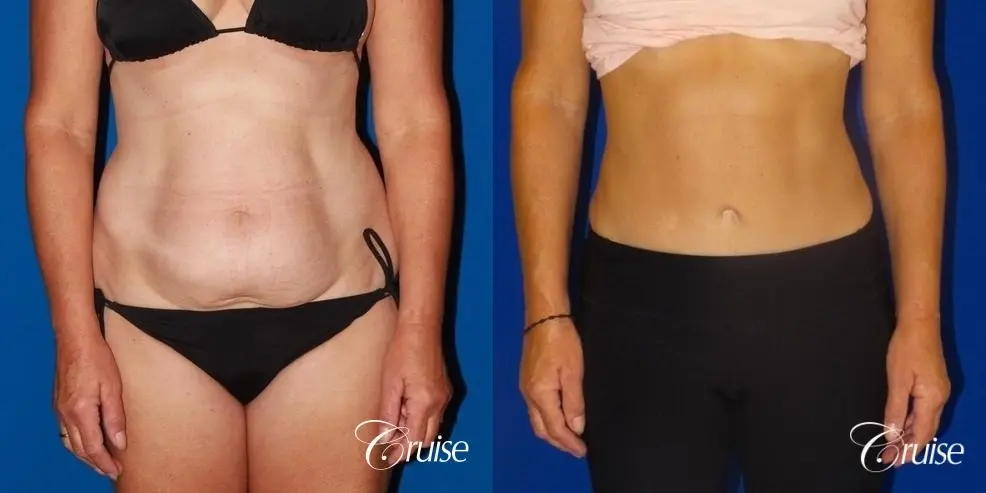 low scar on tummy tuck - Before and After