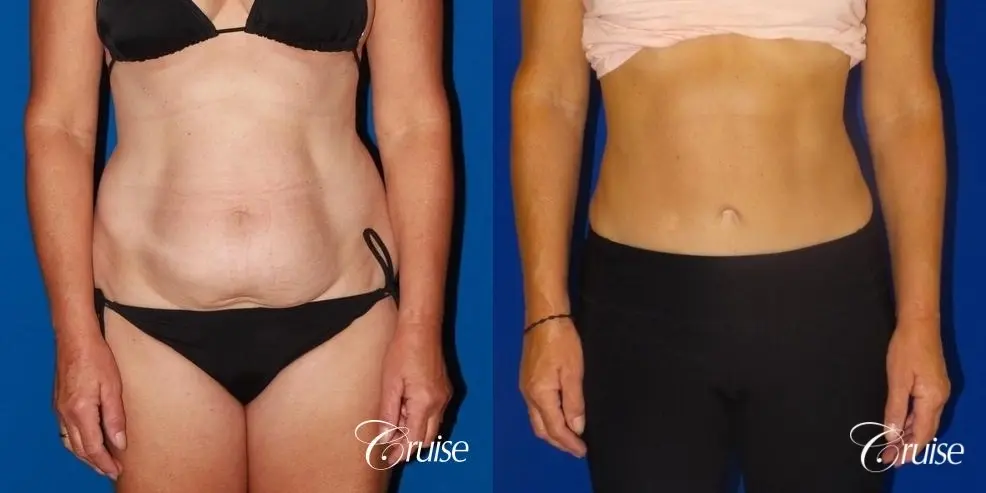 low scar on tummy tuck - Before and After 1