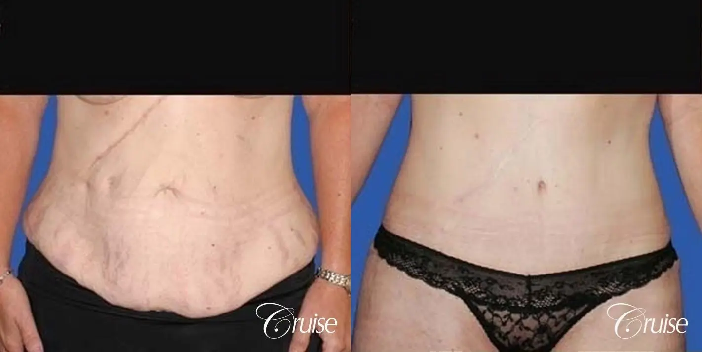 Tummy Tuck Before & After Gallery: Patient 58