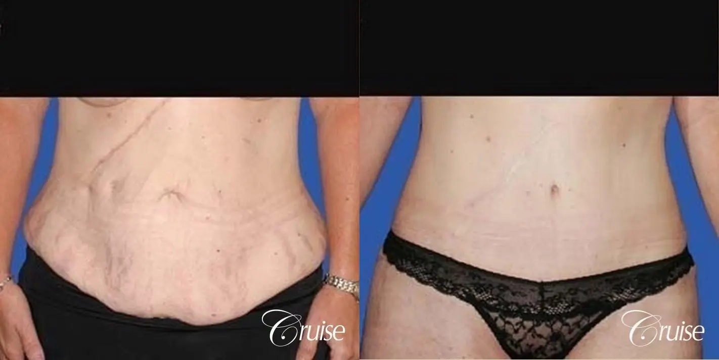 best plastic surgeon for extended tummy tuck after weight loss - Before and After 1