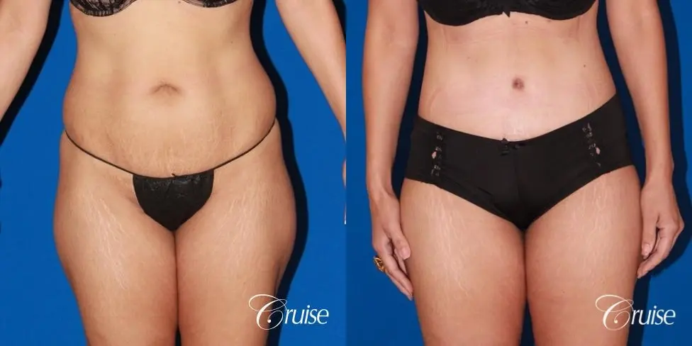 Tummy Tuck & Liposuction: 41 Yr Old Female  - Before and After 1