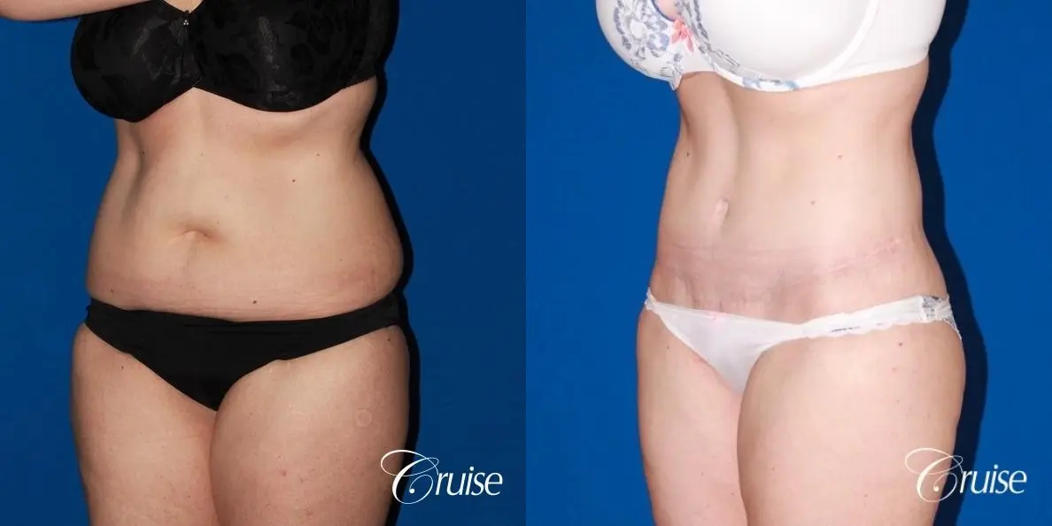 35 Yr Old Female  with Circumferential Tummy Tuck & Liposuction - Before and After 3