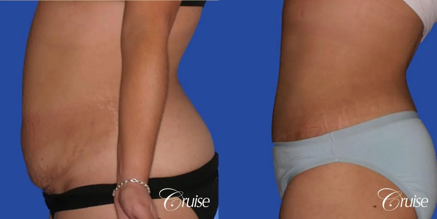 before and after tummy tuck pictures plastic surgeon - Before and After 2