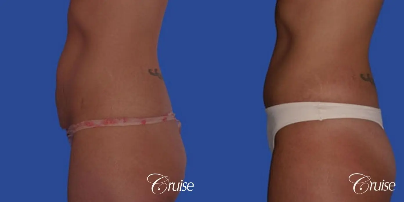 best pictures of abdominoplasty tummy tuck with low scar - Before and After 2