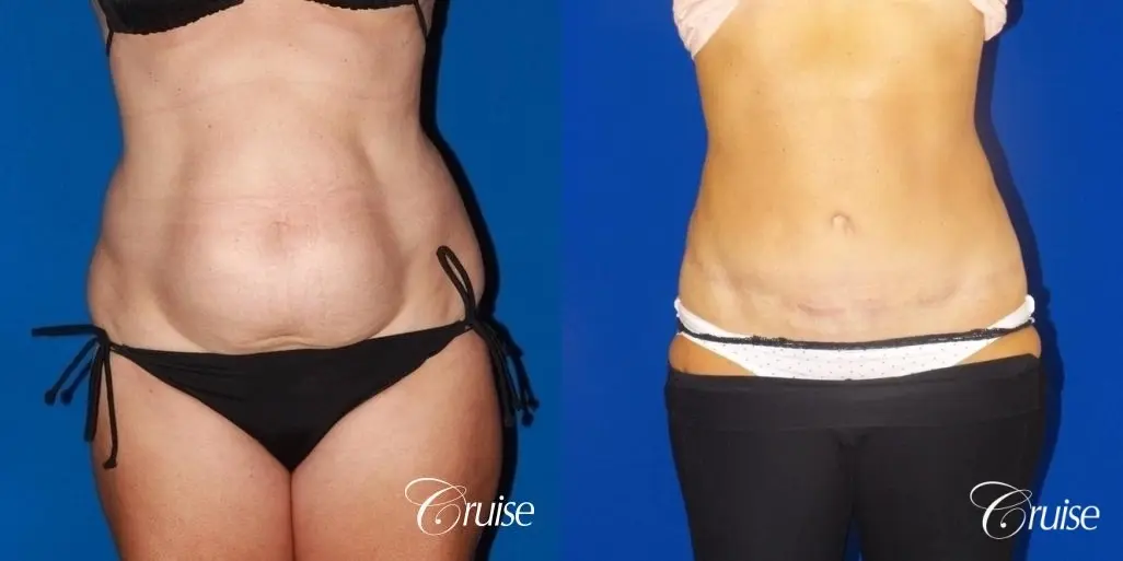 low scar on tummy tuck - Before and After 5