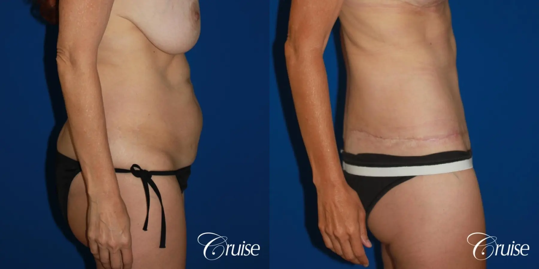 47 Yr Old Liposuction & Circumferential Incision Tummy Tuck - Before and After 4