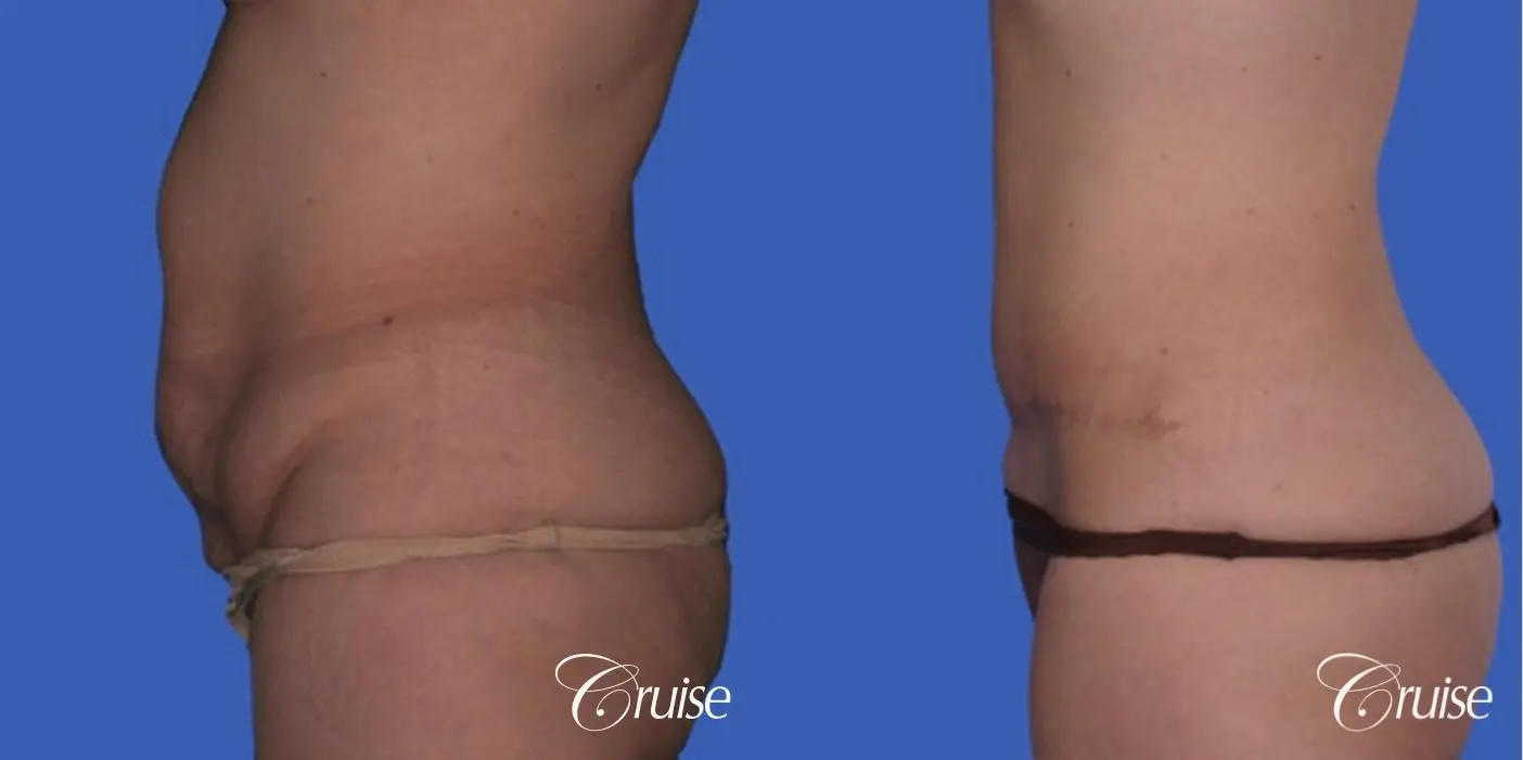 best pictures for standard tummy tuck incision - Before and After 2