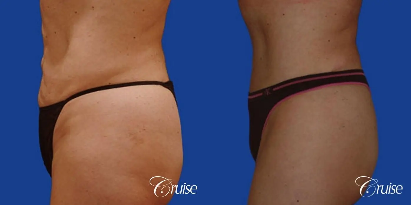 best tummy tuck with top plastic surgeon in Newport Beach - Before and After 2