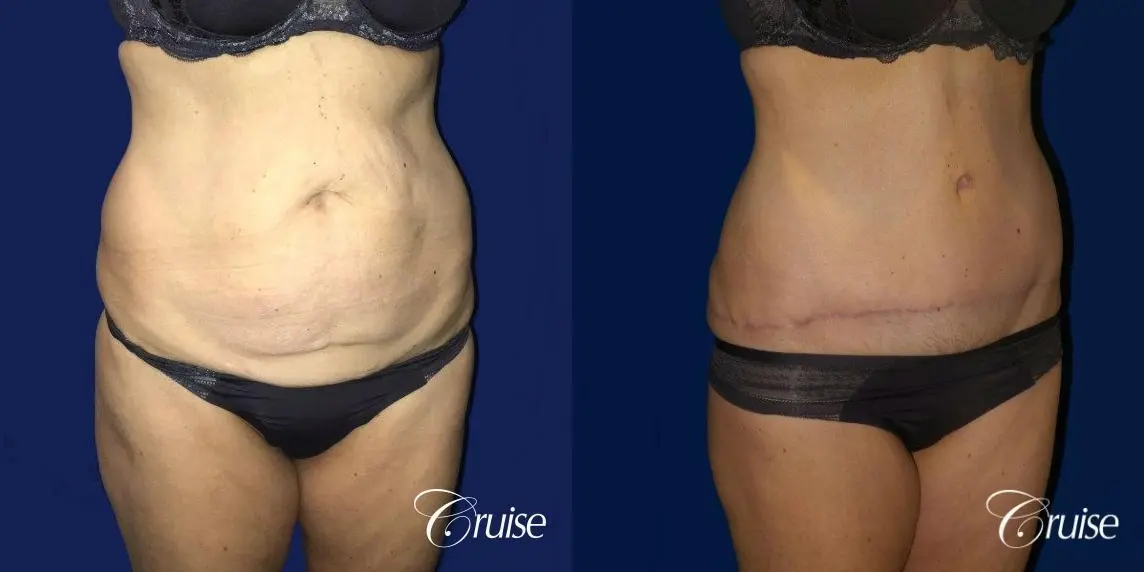 Liposuction & Tummy Tuck Extended Incision  - Before and After 4