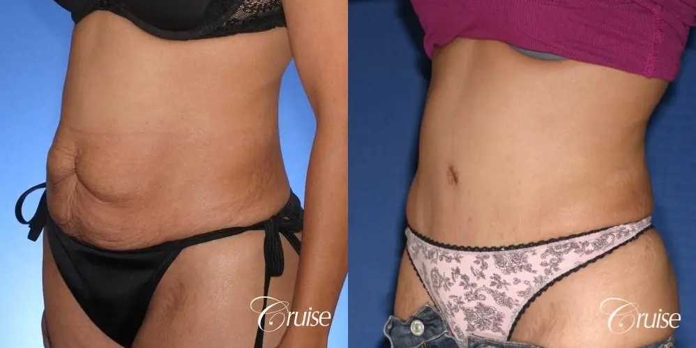 Tummy Tuck: Patient 59 - Before and After 3