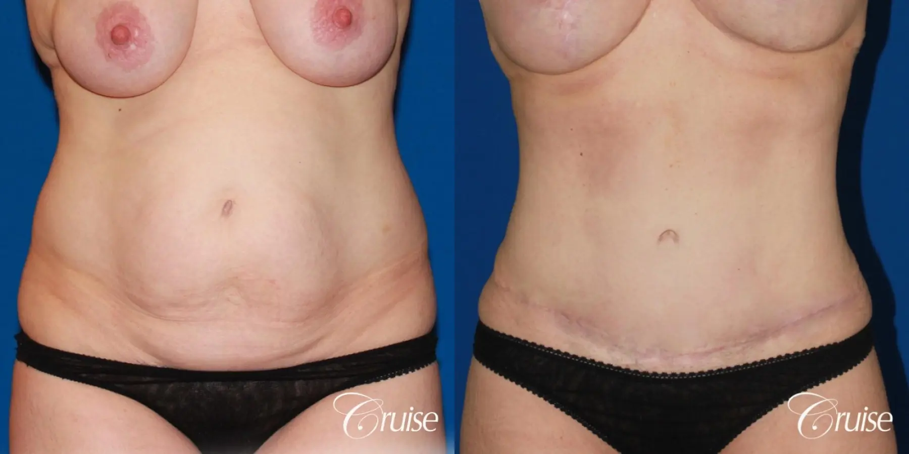 Tummy Tuck: Patient 20 - Before and After  