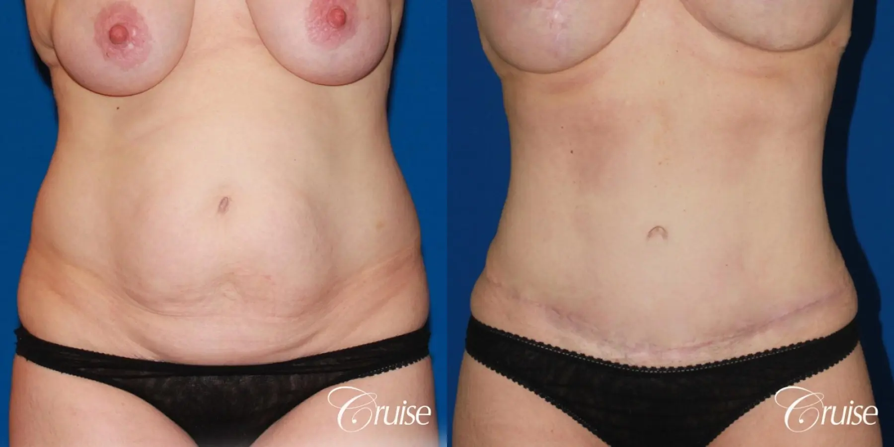 Tummy Tuck: Patient 25 - Before and After 1