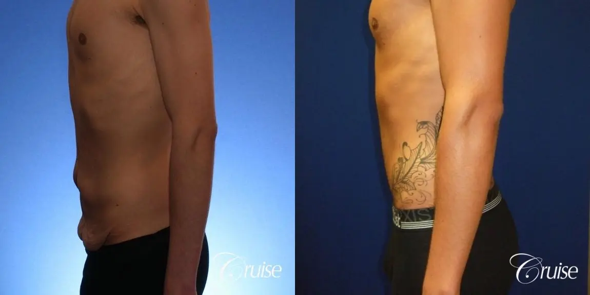 Weight Loss Tummy Tuck: 22 Yr Old Male - Before and After 2