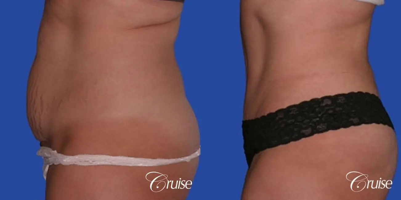 best tummy tuck on 33 year old in Newport Beach - Before and After 2