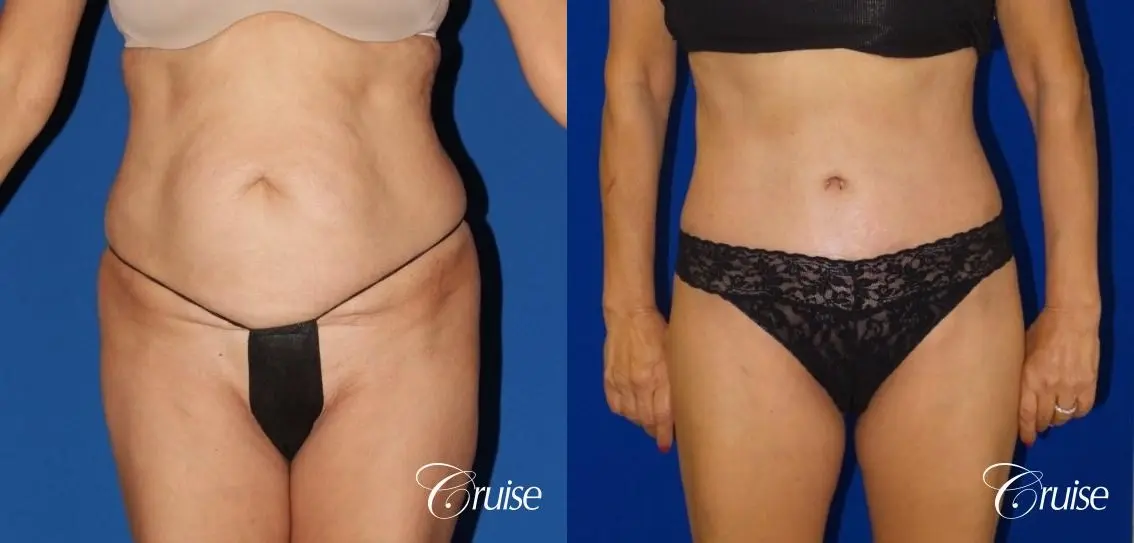 Tummy Tuck Extended Incision - Before and After