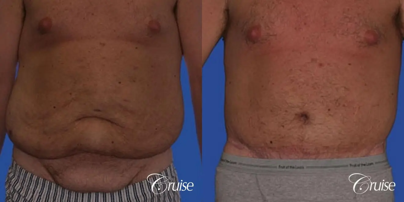 best male extended male abdominoplasty tummy tuck - Before and After 1
