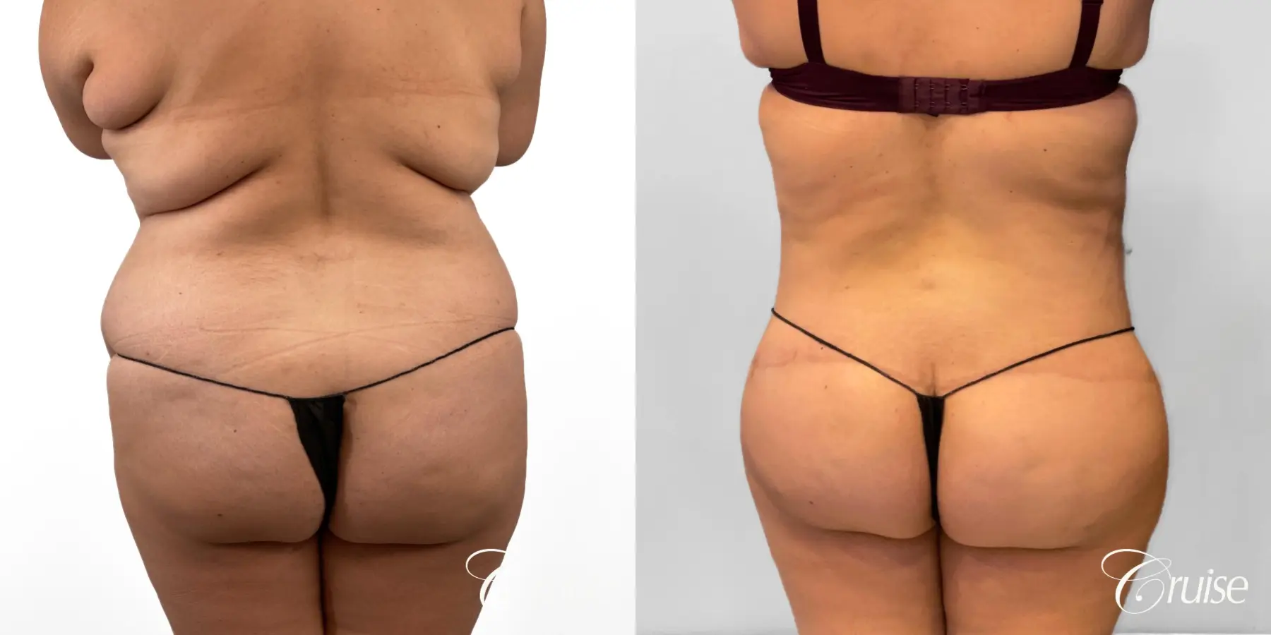 Tummy Tuck: Patient 79 - Before and After 4